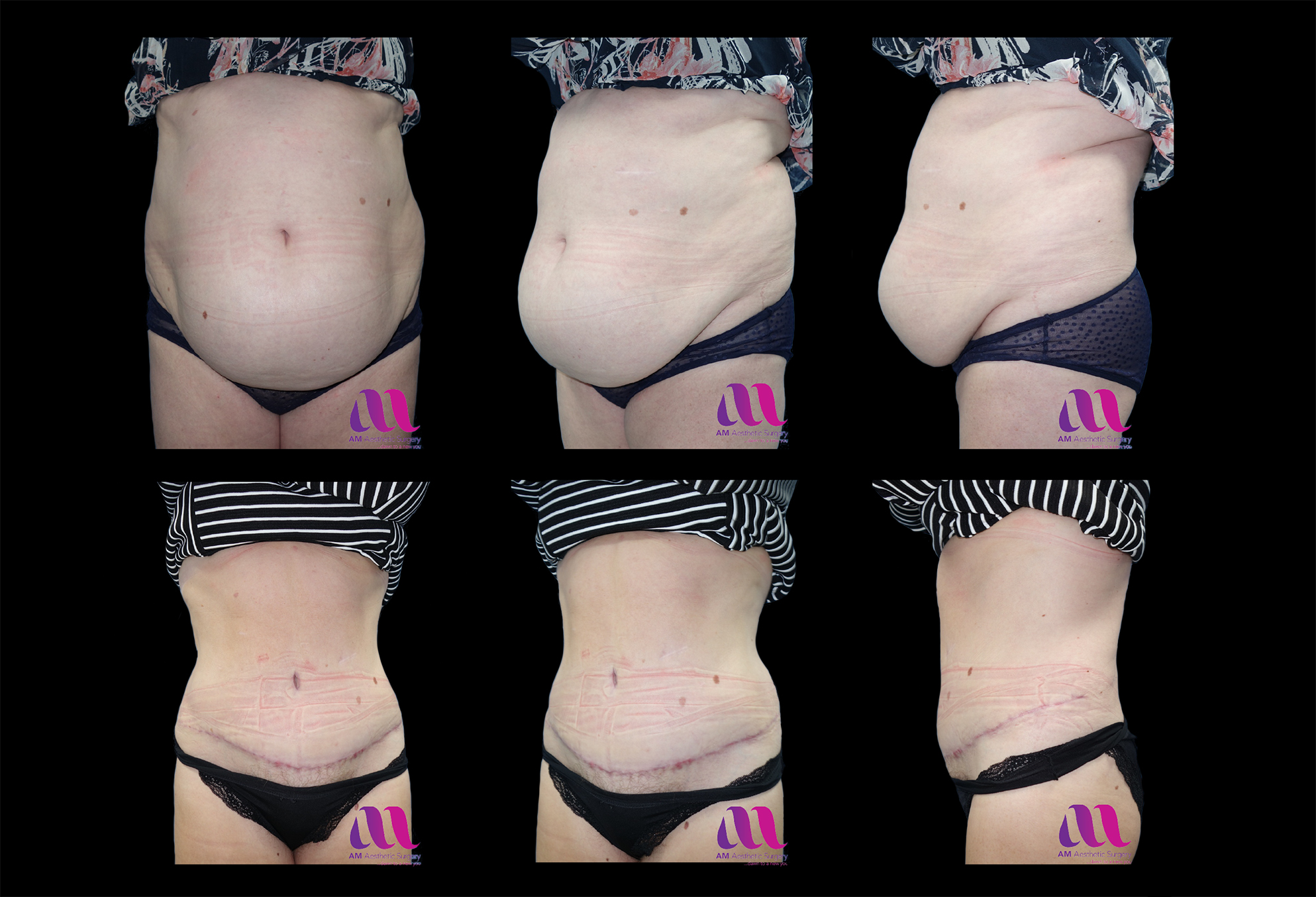Abdominoplasty / Tummy tuck / Repair of post pregnancy split in abdominal  muscles (Divarication) – A M Aesthetic Surgery