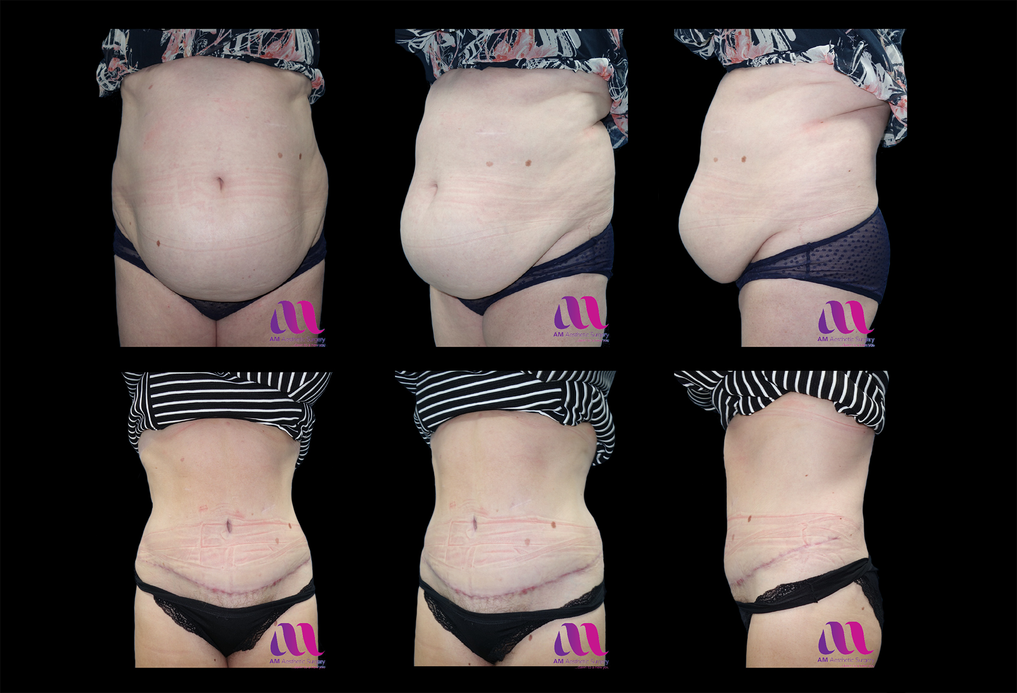 Abdominoplasty / Tummy tuck / Repair of post pregnancy split in