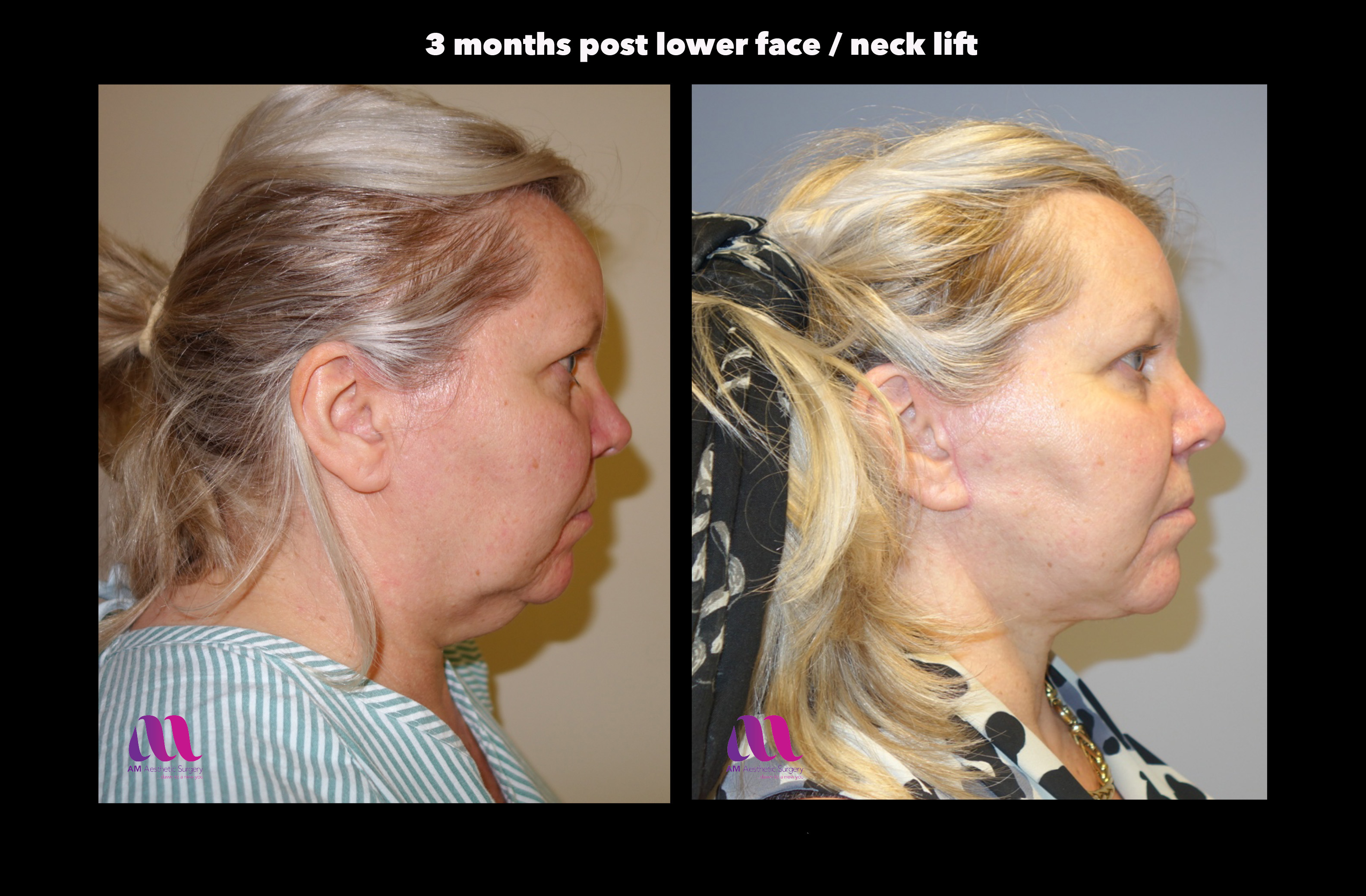 Facelift cosmetic surgery in Ireland