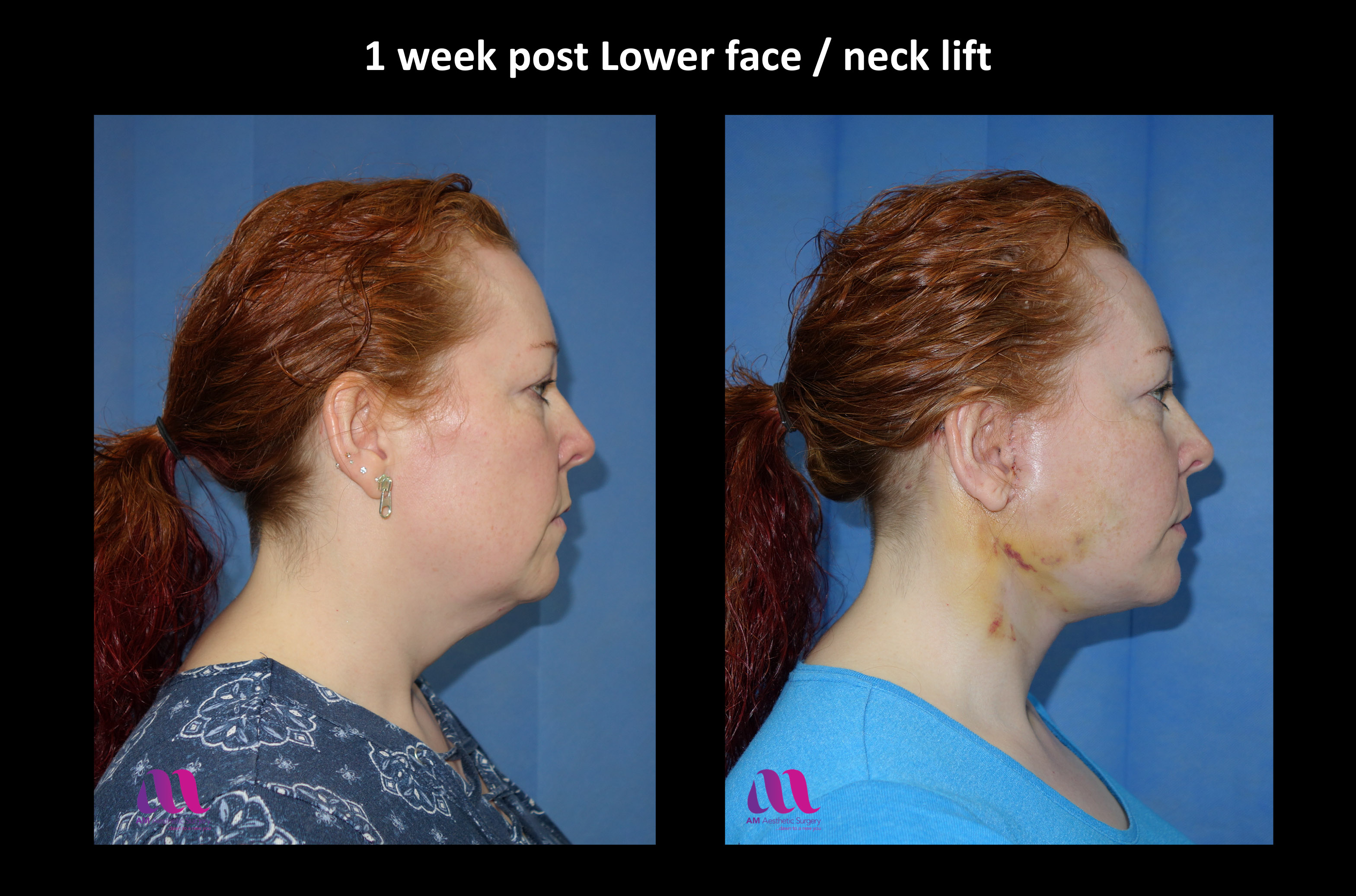 Lower Face Neck Lift A M Aesthetic Surgery