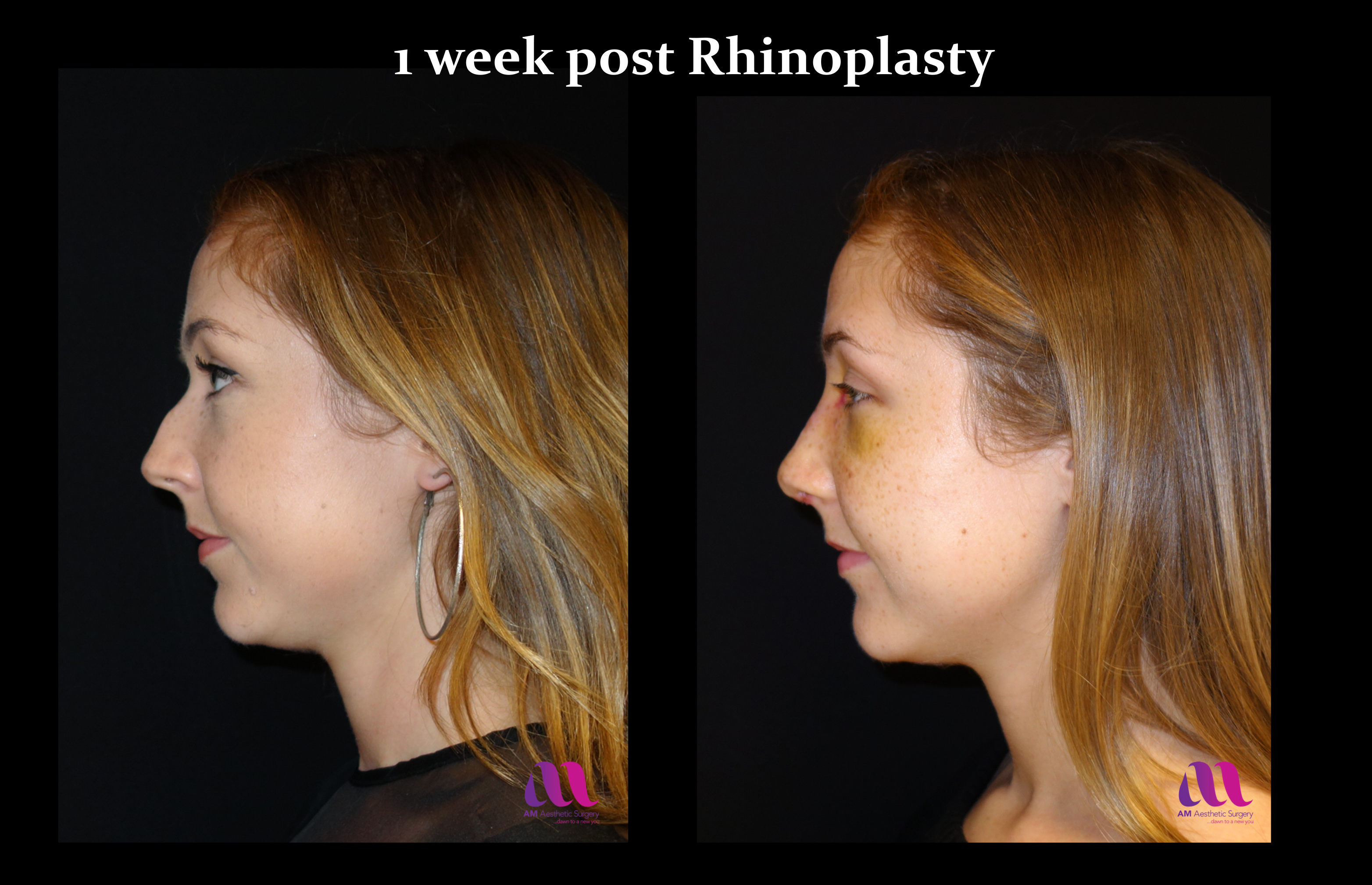 Nose reshaping (rhinoplasty or a nose job) is an operation to change the sh...