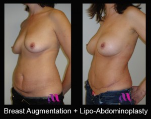 Breast Aug and Lipo-Abd1