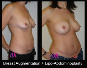 Breast Aug and Lipo-Abd2