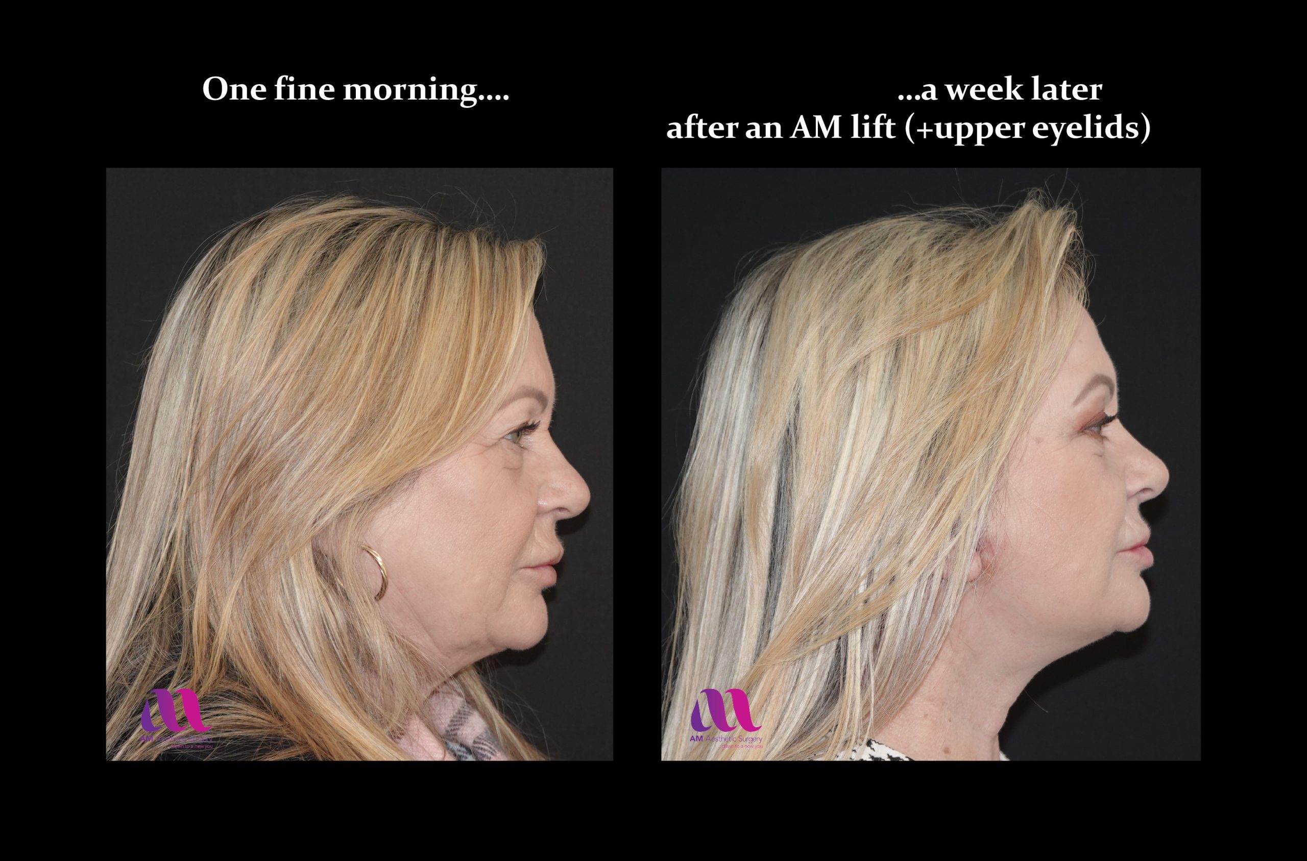 Facelift cosmetic surgery in Ireland